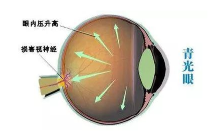 視力訓(xùn)練,視力加盟友